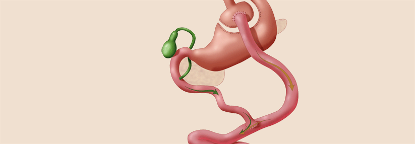 Warum eine Magen Op Türkei für viele Patienten die beste Entscheidung ist
