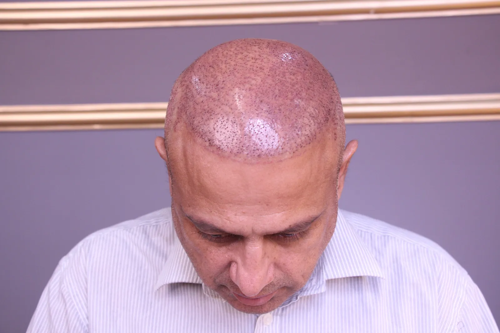 Hair Transplant London – Advanced FUE &amp; FUT Techniques